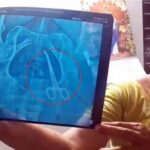 सर्जरी के 5 साल बाद महिला के पेट से कैंची नुमा सर्जिकल टूल निकला, मेडिकल कॉलेज पर लापरवाही के आरोप